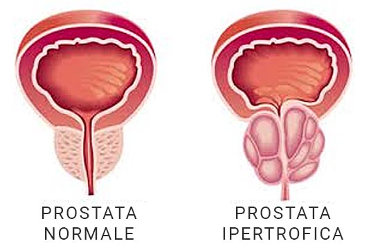 prostata normale ipertrofica 1